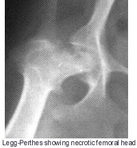 LEGG-PERTHES; SHOWING NECROTIC FEMORAL HEAD - FRED LANTING